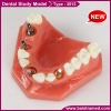 Dental study model / dental implant model